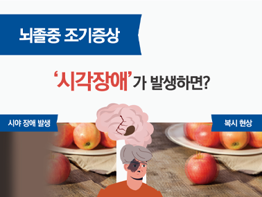 [인포그래픽] 뇌졸중 조기증상-시각장애